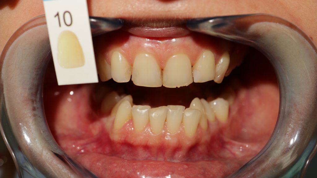 Ambulantné bielenie zubov pred zákrokom