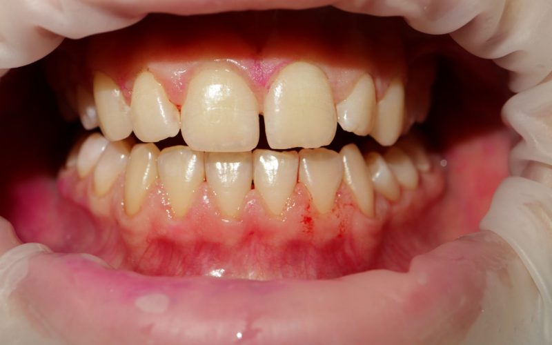 Dentálna hygiena - detský pacient po zákroku