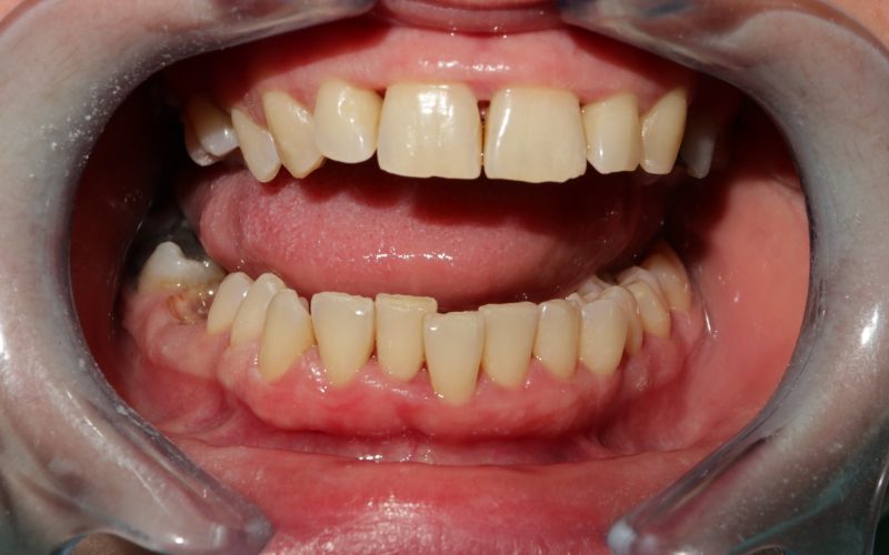 dentálna hygiena výsledok